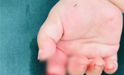 妈妈抱娃拆快递：不慎剪断7月大女儿食指 手术3小时成功接上 ！