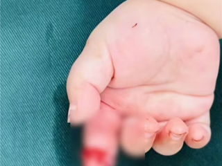 妈妈抱娃拆快递：不慎剪断7月大女儿食指 手术3小时成功接上 ！
