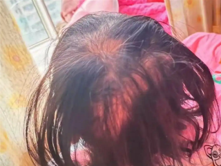 3岁女童突然脱发：查出铊中毒 眼神呆滞 ！