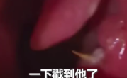 男子竹签卡喉误以为刀片嗓：吃8天药越吃越严重 ！