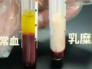 男子抽出草莓奶油血 医生紧急提醒：血脂长期偏高要注意 ！