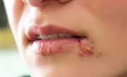 女子嘴角长水泡没重视当晚脑死亡 医生提醒：警惕口唇疱疹 ！