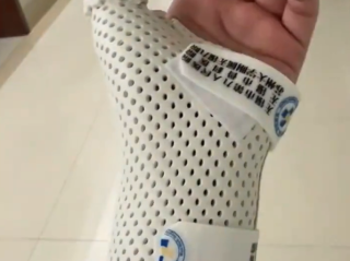 女子睡觉被15斤猫咪压住致手腕骨折 当事人：医生都不相信 !