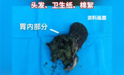 极为罕见！5岁男孩确诊“长发公主综合征” 胃里取出长达16厘米毛发石 !