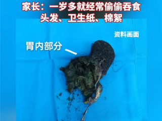 极为罕见！5岁男孩确诊“长发公主综合征” 胃里取出长达16厘米毛发石 !