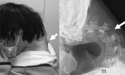 日本25岁男子沉迷手游致脖子长角：无法抬起头 出现吞咽困难 ！